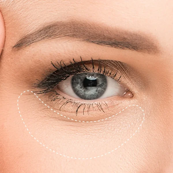 Aclarado de ojeras